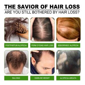 معالجة الشعر بالزنجبيل الأخضر لنمو الشعر