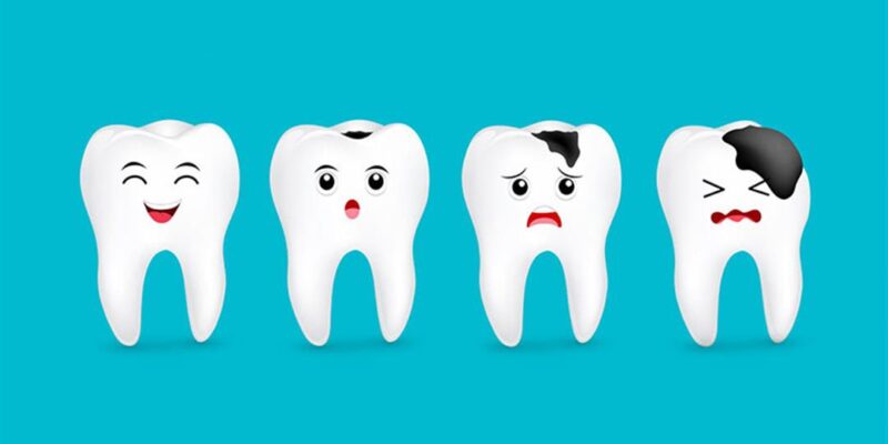 علاج تسوس الأسنان في المنزل: أساليب فعالة لعلاج تسوس الأسنان