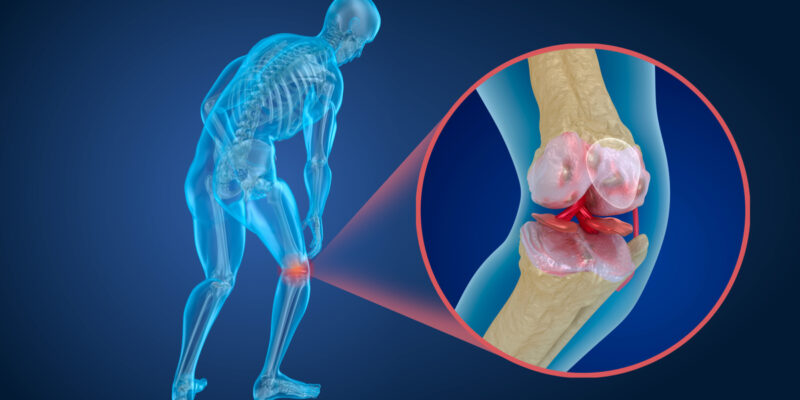 علاج الغضروف المفصلي في الركبة